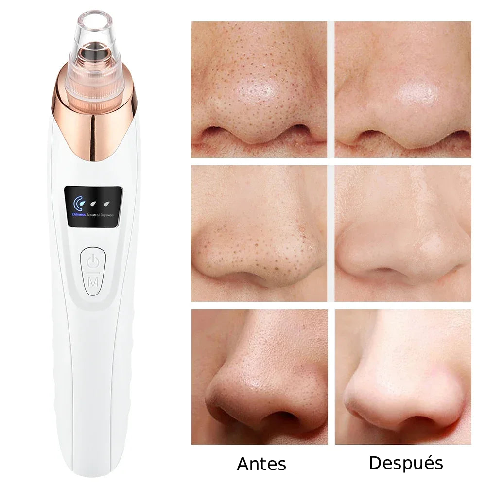 ClearSkin Pro™ - Extractor de impurezas y puntos negros